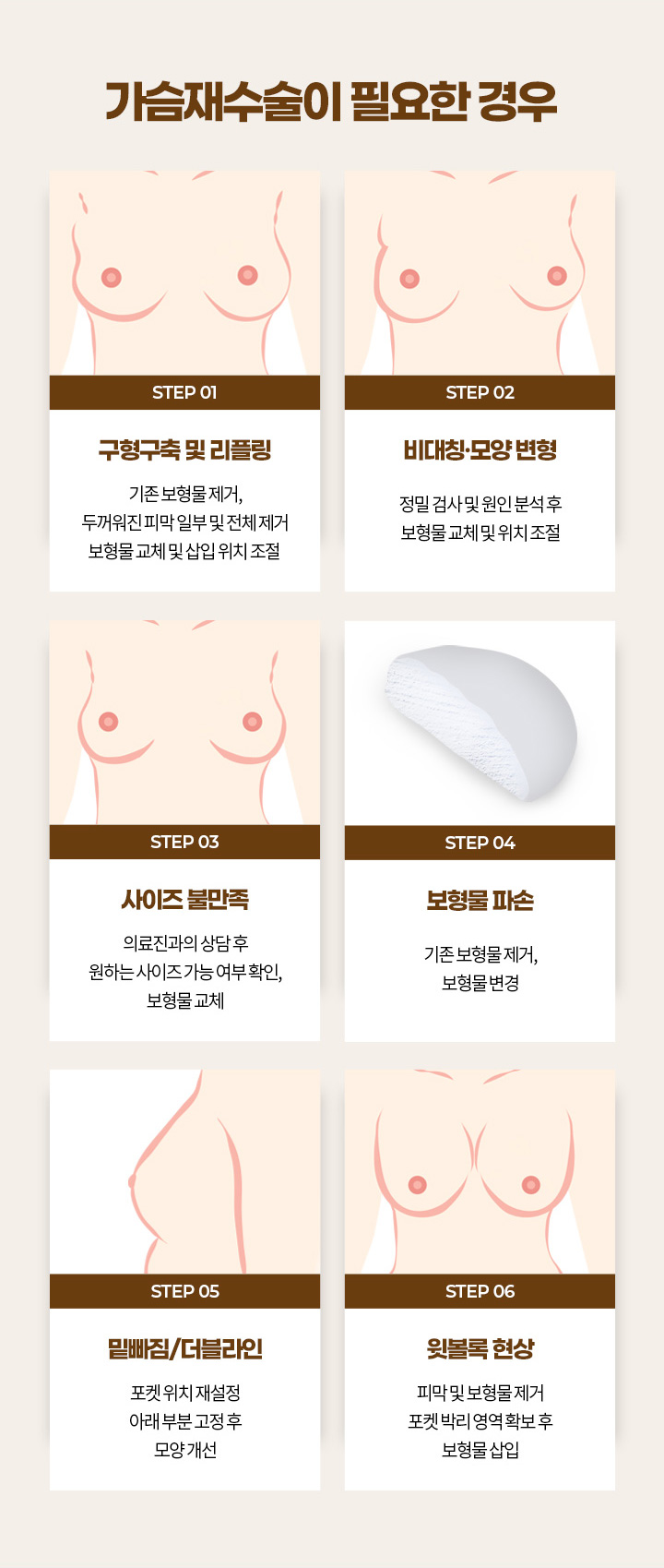 에이탑성형외과 가슴재수술